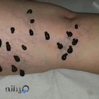 مرکز زالو درمانی آریا