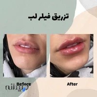 لیزر وان بیوتی