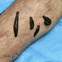 موسسه تحقیقات حجامت رشت(حجامت ،زالودرمانی)مجتمع پزشکی و دندانپزشکی بیستون