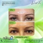 دکتر مسعود تهرانی ، جراح پلک