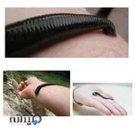 زالو درمانی دروس