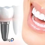ایمپلنت دندان