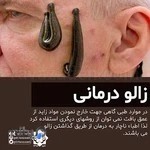 حجامت زالو فصد ماساژ