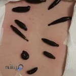 زالو درمانی و حجامت در محل