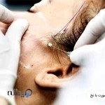 لیزر موهای زائد