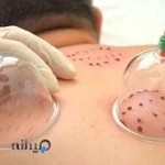 حجامت و ماساژ درمانی در دزفول