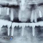 ایمپلنتیوم کلینیک دندانپزشکی ایمپلنت ورامین دکترحمید نقوی -Implantium Varamin Implant Clinic Dr Hamid Naghavi