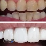 ابرسان برج سفید یک