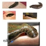 زالو درمانی دیباجی