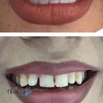 دندانپزشکی زیبایی لمینت کامپوزیت ونیر