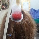 طب سنتی و سوزنی و تل گیری گلو