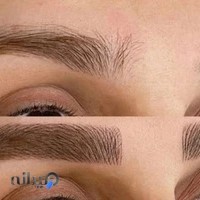 میکروبلیدینگ مائده سلیمی