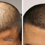 میکرو اسکالپ شمال و اکستنشن لیلی لحیم چی