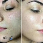 تکنیک پوست کره ای