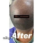 میکروبلیدینگ آقایان اصفهان