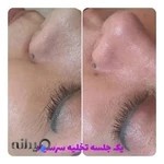 فیشیال و پاکسازی پوست نگار