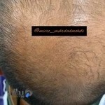 کیلینک تخصصی میکرواسکالپ اصفهان