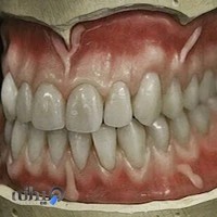 دندانسازی مایرسون