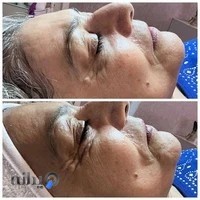 پاکسازی پوست شادی