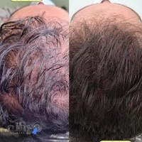 کلینیک میکرواسکالپ یکتا