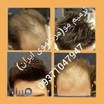 ترمیم مو ۰۹۳۷۱۰۴۷۹۴۷