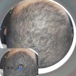 اسکالپ سر کرمان آرسین