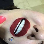 کلینیک دندانپزشکی نکو |ایمپلنت| لمینت سرامیک و کامپوزیت ونیر