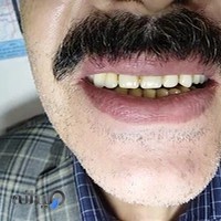 لابراتوار دندانسازی ثامن دندان مصنوعی ژله ای جایگزین ایمپلنت محافظ لثه گیر لثه بند رزمی