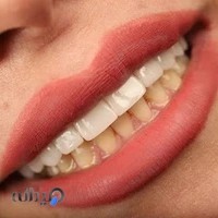 متخصص ایمپلنت و لمینت؛ دکتر محمد میرشکار