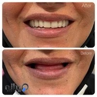 مرکز دندان مصنوعی ژله ای تهران - مستر دندانم