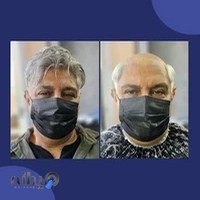 مرکز تخصصی پروتز مو هیمن