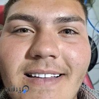 دندانسازی صدف دیش (تجربی)