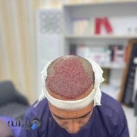 کاشت مو ، ابرو ، ریش احسان انصاری مقدم