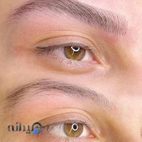 مرجان نبی میکروبلیدینگ