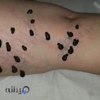 مرکز زالو درمانی آریا