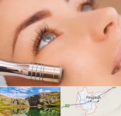 میکرودرم در فیروزکوه