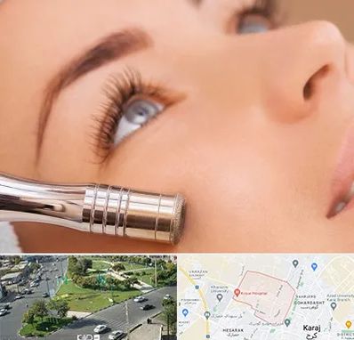 میکرودرم در شاهین ویلا کرج