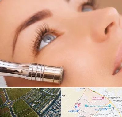 میکرودرم در الهیه مشهد