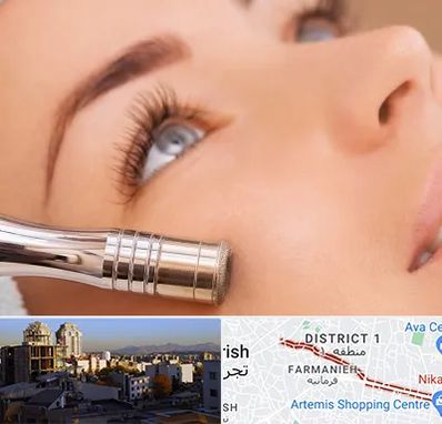 میکرودرم در فرمانیه 