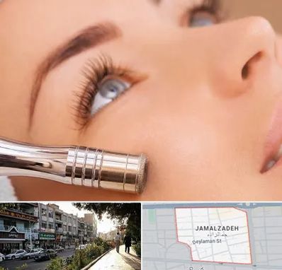 میکرودرم در خیابان جمالزاده