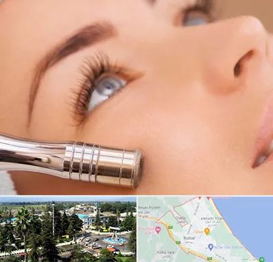 میکرودرم در رودسر