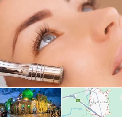 میکرودرم در آستانه اشرفیه