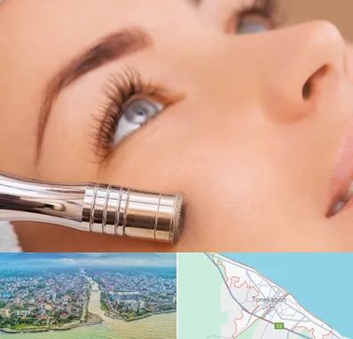 میکرودرم در تنکابن