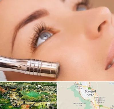 میکرودرم در بروجرد