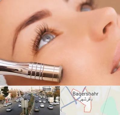 میکرودرم در باقرشهر