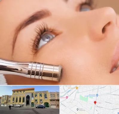 میکرودرم در زنبیل آباد قم