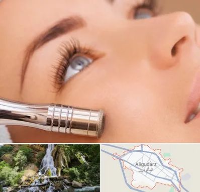 میکرودرم در الیگودرز