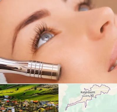 میکرودرم در کلاردشت