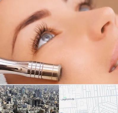 میکرودرم در جیحون