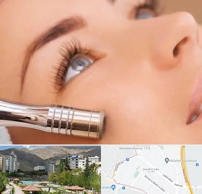 میکرودرم در شهر زیبا 